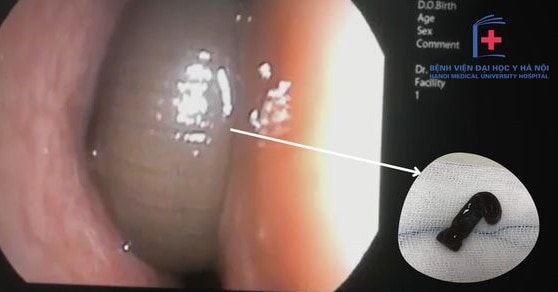 Phát hiện con đỉa 6 cm sống ba tháng trong mũi bệnh nhân Phát hiện con đỉa 6 cm sống ba tháng trong mũi bệnh nhân