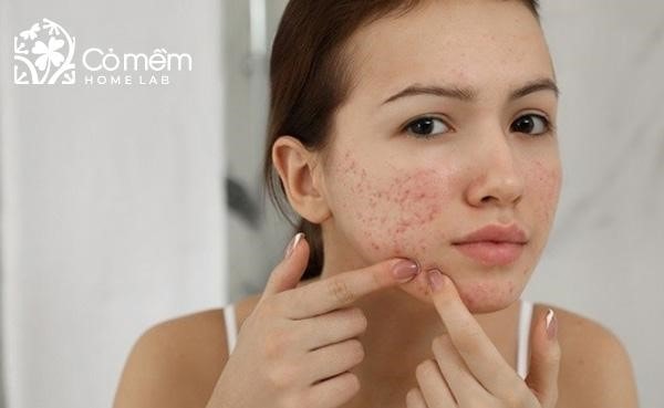 Da dầu mụn - nỗi ám ảnh của rất nhiều bạn trẻ hiện nay