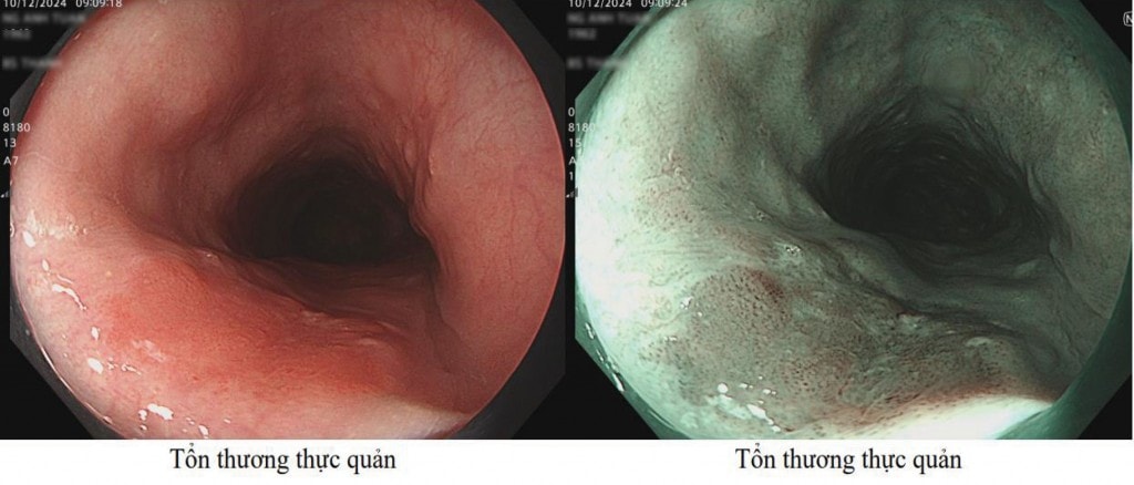 Hình ảnh nội soi thông thường (bên trái) và công nghệ nội soi NBI phóng đại, tổn thương quan sát được có cấu trúc mạch máu biến đổi type B1, nghi ngờ ác tính (bên phải)