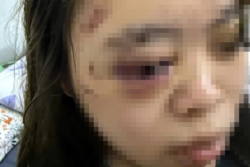 Nữ sinh A.T bị đánh bầm tím mặt