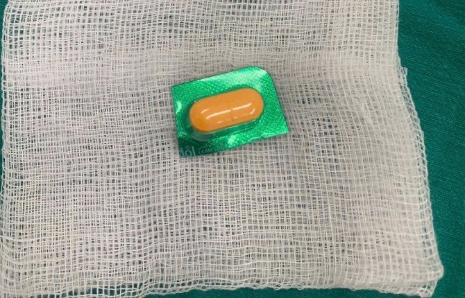 Gắp thành công viên thuốc còn nguyên vỏ sắc nhọn ở thực quản của bệnh nhân - Tin tức sự kiện - Cổng thông tin điện tử Sở y tế Hà Nội