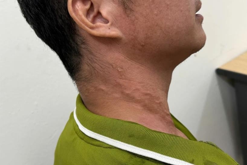 [Podcast] Hà Nội ghi nhận ca mắc giun rồng thứ 26 tại Việt Nam