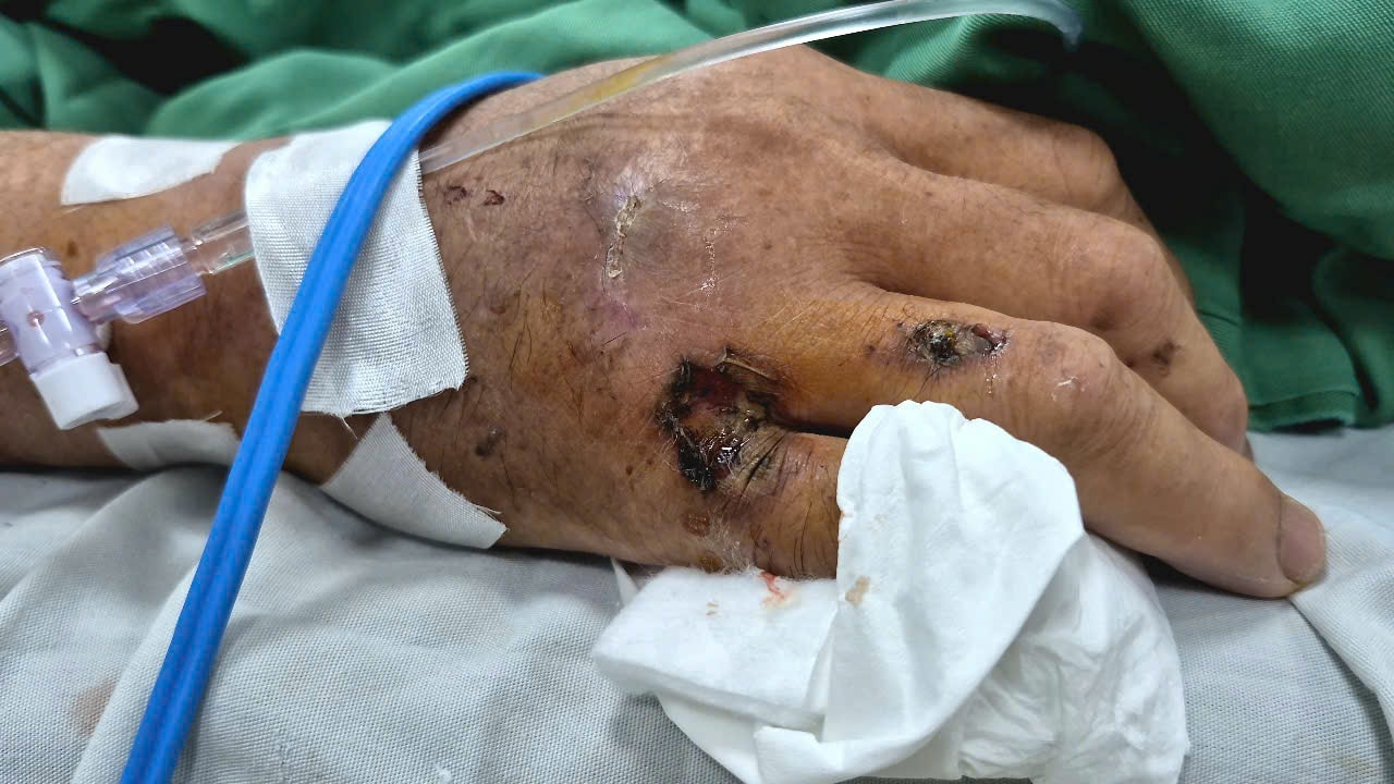 dau-vet-dien-giat.jpg