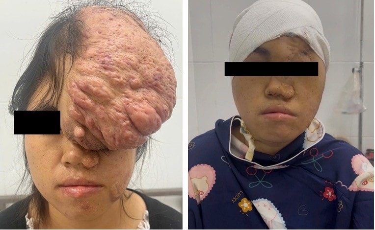 Ca phẫu thuật được thực hiện vào sáng ngày 28/8, với sự tham gia của 6 phẫu thuật viên và 3 bác sĩ gây mê hồi sức của Bệnh viện Đa khoa Bình Dương