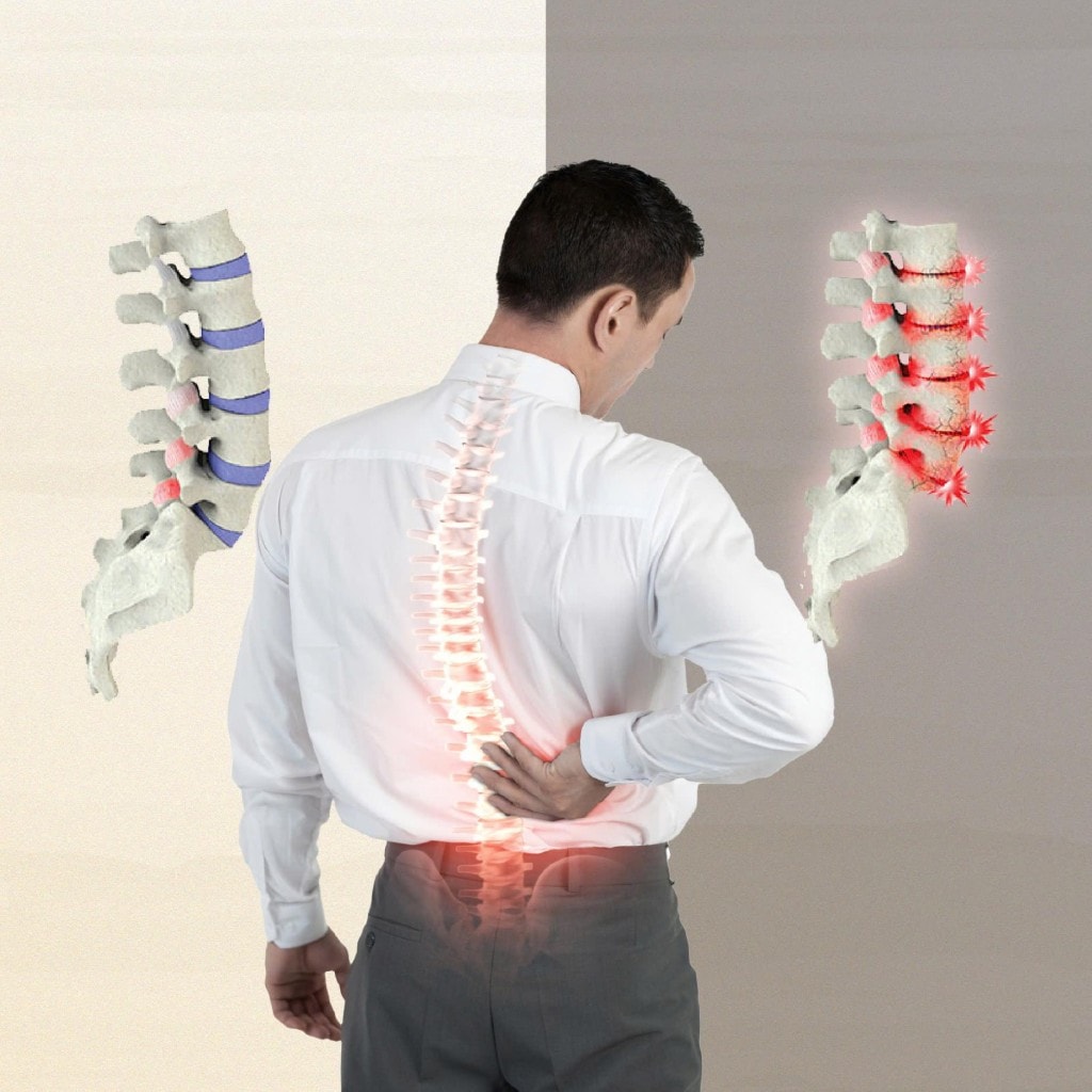 Hình ảnh minh hoạ khớp cột sống thắt lưng bị thoái hoá