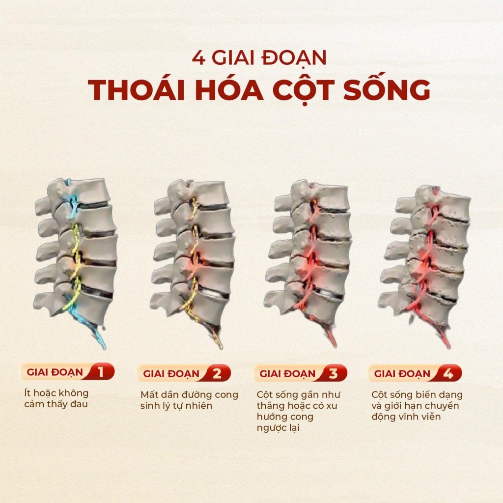 Thoái hóa khớp: Phòng bệnh để giảm gánh nặng cho xương khớp