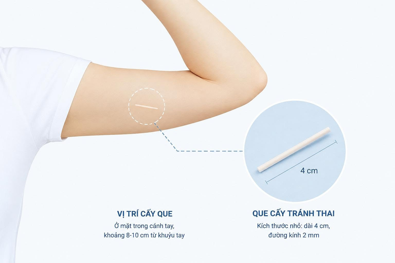 Vị trí que cấy tránh thai sẽ được cấy trên cánh tay. Ảnh: BVCC 