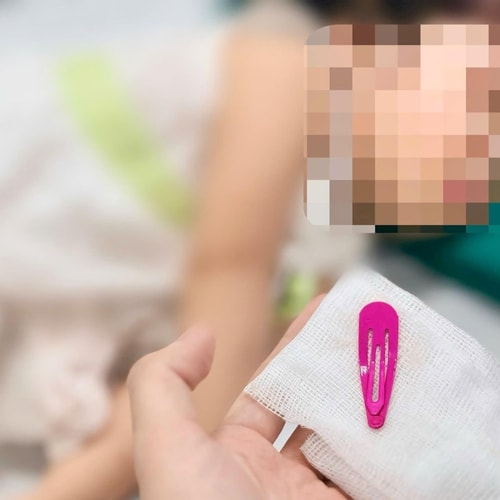 [Podcast] Bé gái nuốt kẹp tóc kim loại - Cảnh báo tai nạn “giấu mặt” cha mẹ cần biết