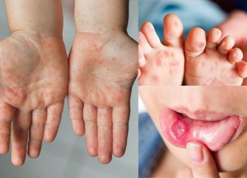 [Podcast] Ca mắc tay chân miệng tăng đột biến: Siết phòng dịch, bảo vệ trẻ nhỏ