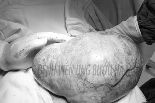 Cắt u buồng trứng khổng lồ cho bệnh nhân 81 tuổi