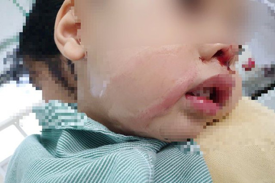 Người lớn bất cẩn, bé trai 2 tuổi bị nhỏ nhầm axít vào mũi