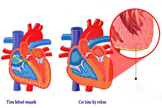 Những người tiếp xúc với hai trường hợp tử vong do viêm cơ tim sức khỏe đều bình thường