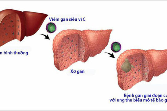 Mất bao lâu để viêm gan vi rút phát triển thành xơ gan, ung thư gan?