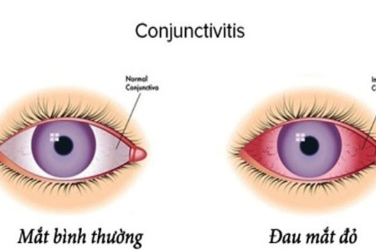 Bác sĩ tại nhà: Đau mắt đỏ có thể tự khỏi?