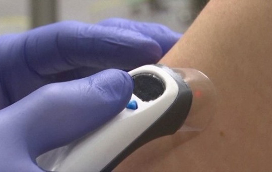 Công nghệ tia laser tiêm vắc xin không đau đớn