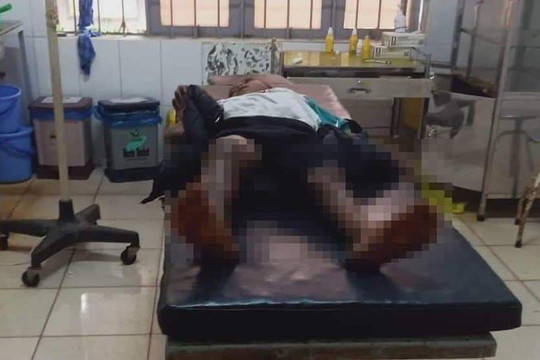 Đắk Lắk: Thông tin bé trai 8 tuổi bị đốt bỏng 2 chân là thất thiệt