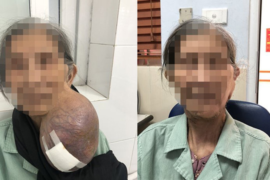 Cắt bỏ khối u “khủng” tồn tại hơn 40 năm trên mặt một cụ bà ở Hà Nội