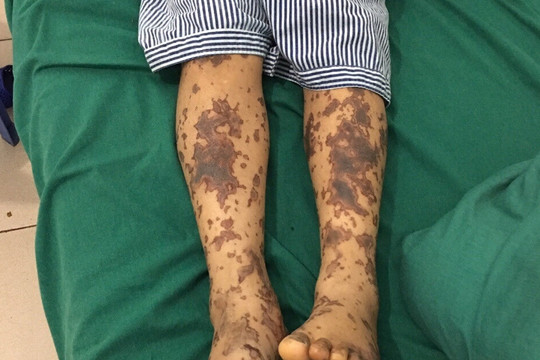 Không ăn tiết canh, một người đàn ông tại Hà Nội vẫn nhiễm liên cầu khuẩn lợn