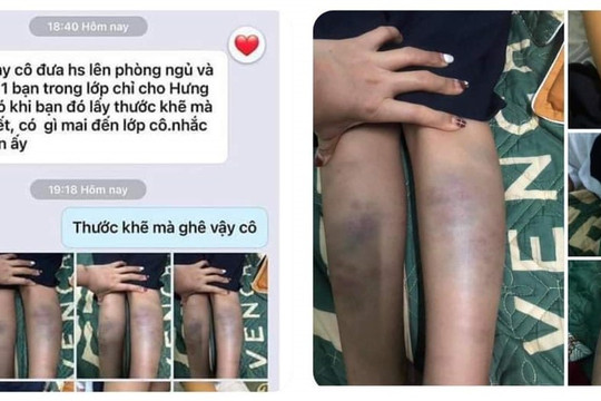 Xác định nguyên nhân vết bầm tím trên người một học sinh lớp 1 tại Đà Nẵng