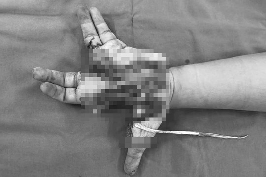 Điện thoại bất ngờ phát nổ khiến bé trai 14 tuổi bị dập nát bàn tay
