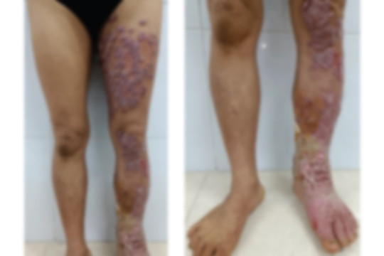 Nữ bệnh nhân bị sùi loét một bên chân do bệnh nhiệt đới ''bị lãng quên''