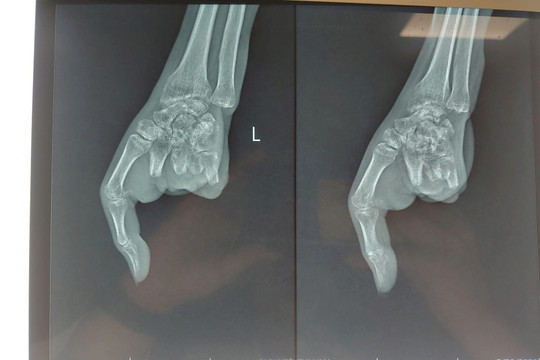 Ghép thành công ngón chân thành ngón tay cho bệnh nhân bị nát tay trái