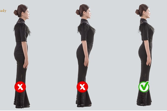 Đâu là giải pháp khắc phục gù lưng, lưng còng hiệu quả nhất cho phái nữ?
