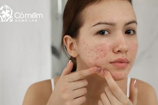Bí quyết lựa chọn nước tẩy trang cho da dầu mụn phù hợp