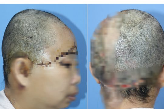 Nối thành công mảnh da đầu bị đứt rời cho một phụ nữ