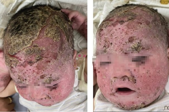 Bé trai 8 tháng tuổi bị bong tróc toàn bộ da mặt, đầu sau khi tắm nhiều loại lá