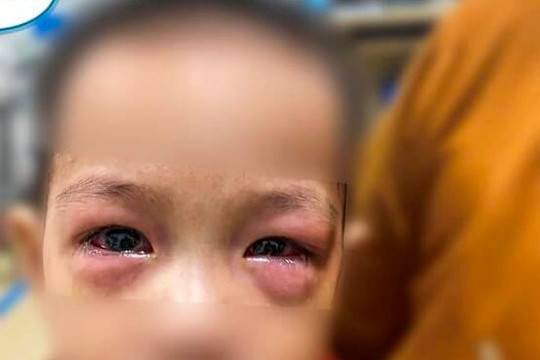 Dịch đau mắt đỏ xuất hiện, nhiều ca biến chứng