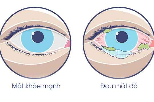 Nguy cơ nhiễm trùng nếu tự sử dụng thuốc nhỏ mắt có corticoid