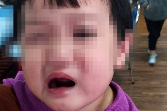 Bé 2 tuổi bị méo miệng vì bố mẹ chở đi chơi bằng xe máy vào tối muộn 