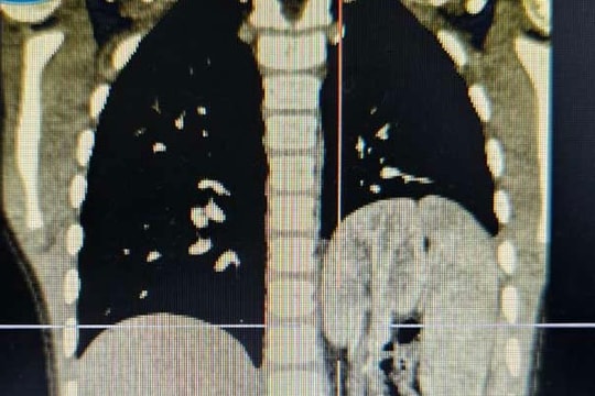 Em bé 6 tuổi ở Hà Nội có thận “lạc chỗ” lên lồng ngực