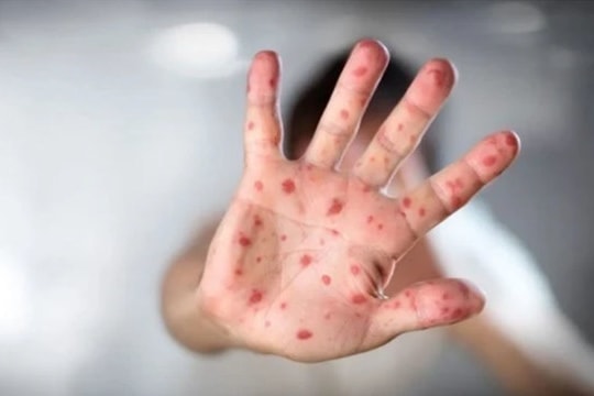 Hà Nội Kịp thời phát hiện ca nghi mắc bệnh đậu mùa khỉ