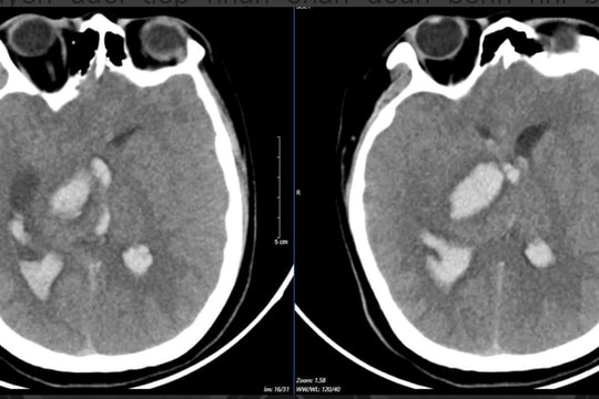Bé 15 tuổi tử vong sau cơn đau đầu đột ngột
