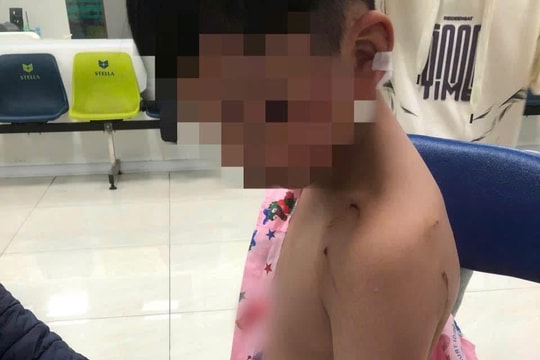 Đi chúc Tết, bé trai 10 tuổi ở Hà Nội bị chó tấn công