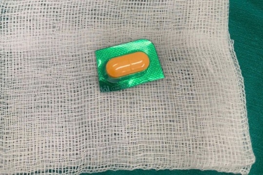 Gắp thành công vỏ thuốc sắc nhọn ở thực quản bệnh nhân