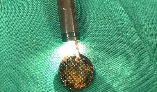 Gắp dị vật pin cúc áo kẹt trong thực quản trẻ nhỏ