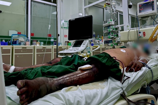 Nguy kịch vì bị gai đâm ở đầm tôm
