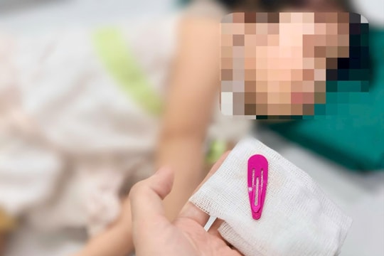 [Podcast] Bé gái nuốt kẹp tóc kim loại - Cảnh báo tai nạn “giấu mặt” cha mẹ cần biết