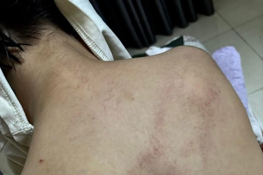 Cục Bà mẹ và Trẻ em lên tiếng về vụ trẻ bị bạo hành ở Trường Mầm non Gia Thụy