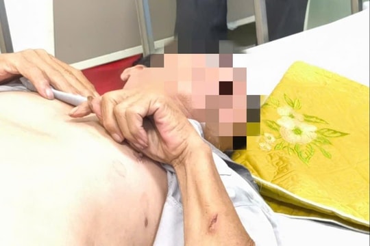 Nguy kịch vì bị chó cắn nhưng không tiêm phòng