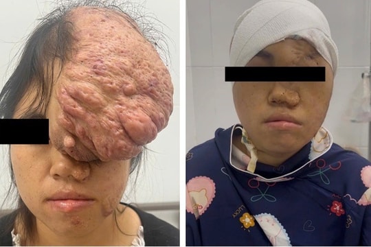 Sở Y tế TP Hồ Chí Minh: Phẫu thuật thành công khối u sụn xương sọ cho bệnh nhân dân tộc Mông