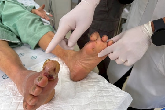 Cẩn trọng với các tổn thương bàn chân ở người bệnh đái tháo đường