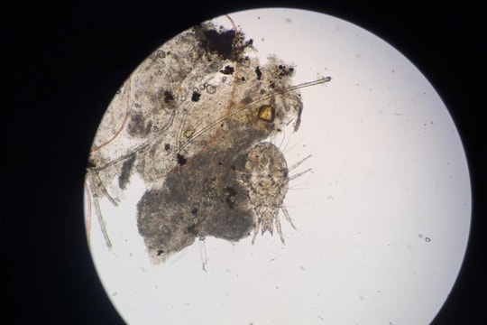 Cẩn trọng khi ngứa mắt kéo dài, cộm, đỏ mi, viêm tái phát