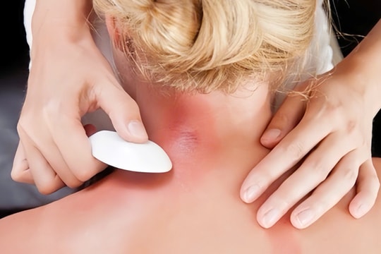Không nên cạo gió cho người mắc sốt xuất huyết