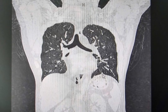 Phát hiện một trường hợp lâm sàng hiếm gặp