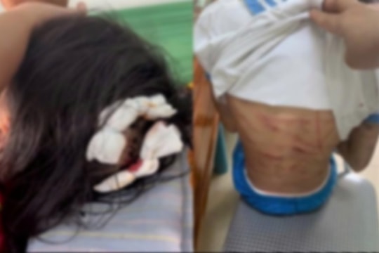 Hà Tĩnh Xác minh thông tin bé gái lớp 5 nghi bị cha dượng bạo hành, cơ thể chi chít vết thương
