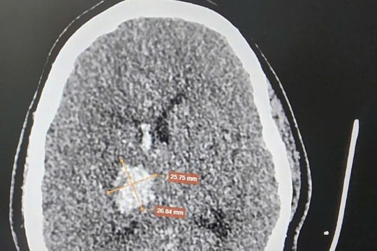 Xử trí thành công một ca hội chứng mạch máu hiếm gặp